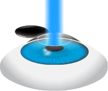 Eximer Laser Reshapes Cornea