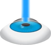 Eximer Laser Reshapes Cornea