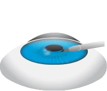 Clear Lens is Removed